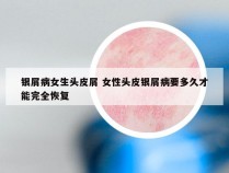 银屑病女生头皮屑 女性头皮银屑病要多久才能完全恢复