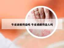 牛皮顽癣传染吗 牛皮病癣传染人吗