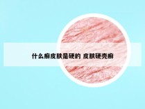 什么癣皮肤是硬的 皮肤硬壳癣