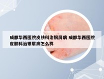 成都华西医院皮肤科治银屑病 成都华西医院皮肤科治银屑病怎么样