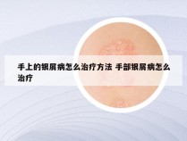 手上的银屑病怎么治疗方法 手部银屑病怎么治疗