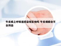 牛皮癣上呼吸道感染有影响吗 牛皮病癣会不会传染