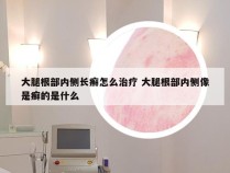 大腿根部内侧长癣怎么治疗 大腿根部内侧像是癣的是什么