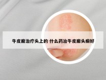 牛皮廨治疗头上的 什么药冶牛皮廨头癣好