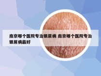 南京哪个医院专治银屑病 南京哪个医院专治银屑病最好