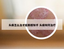 头癣怎么治才能断根知乎 头癣如何治疗