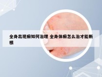 全身出现癣如何治理 全身体癣怎么治才能断根