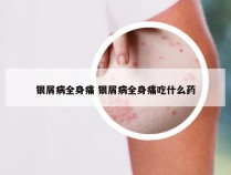 银屑病全身痛 银屑病全身痛吃什么药