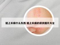 腿上长癣什么东西 腿上长癣的症状图片大全