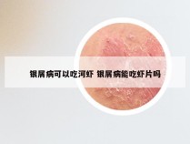 银屑病可以吃河虾 银屑病能吃虾片吗