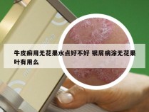 牛皮癣用无花果水点好不好 银屑病涂无花果叶有用么