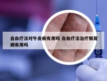 自血疗法对牛皮癣有用吗 自血疗法治疗银屑病有用吗