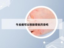 牛皮癣可以擦肤得安药膏吗