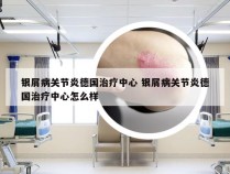 银屑病关节炎德国治疗中心 银屑病关节炎德国治疗中心怎么样