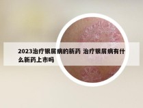 2023治疗银屑病的新药 治疗银屑病有什么新药上市吗