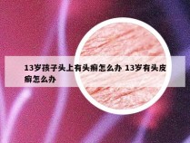 13岁孩子头上有头癣怎么办 13岁有头皮癣怎么办