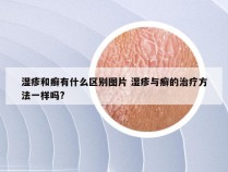 湿疹和癣有什么区别图片 湿疹与癣的治疗方法一样吗?