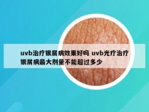 uvb治疗银屑病效果好吗 uvb光疗治疗银屑病最大剂量不能超过多少