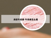 鼻腔牛皮癣 牛鼻癣怎么看