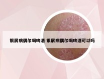 银屑病偶尔喝啤酒 银屑病偶尔喝啤酒可以吗