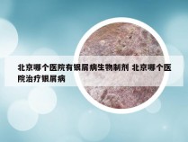 北京哪个医院有银屑病生物制剂 北京哪个医院治疗银屑病