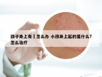 孩子身上有廯怎么办 小孩身上起的是什么?怎么治疗