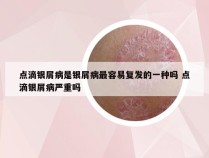 点滴银屑病是银屑病最容易复发的一种吗 点滴银屑病严重吗