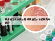 银屑病怎么涂润肤霜 银屑病怎么涂润肤霜效果好