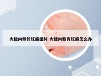 大腿内侧长红癣图片 大腿内侧有红癣怎么办