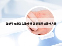 背部牛皮癣怎么治疗呀 背部银屑病治疗方法