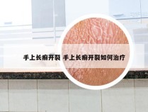 手上长癣开裂 手上长癣开裂如何治疗