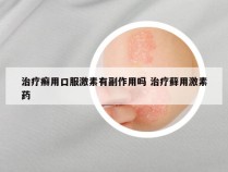 治疗癣用口服激素有副作用吗 治疗藓用激素药