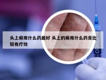 头上癣用什么药最好 头上的癣用什么药膏比较有疗效