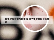 得牛皮癣会得灰指甲吗 得了牛皮病癣会长寿吗