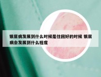 银屑病发展到什么时候是往回好的时候 银屑病会发展到什么程度