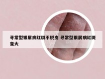 寻常型银屑病红斑不脱皮 寻常型银屑病红斑变大