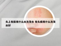 头上有藓用什么水洗发水 有头癣用什么洗发水好