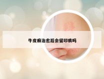 牛皮癣治愈后会留印痕吗