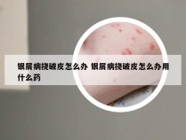 银屑病挠破皮怎么办 银屑病挠破皮怎么办用什么药