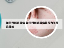 如何判断银屑病 如何判断银屑病是否为关节炎性的