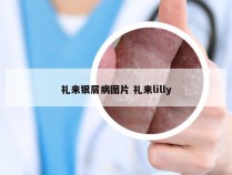 礼来银屑病图片 礼来lilly