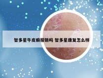 智多星牛皮癣报销吗 智多星康复怎么样