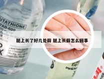 腿上长了好几处藓 腿上长藓怎么回事