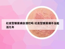 红皮型银屑病会溃烂吗 红皮型银屑病不治能活几年