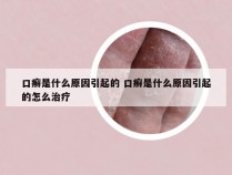 口癣是什么原因引起的 口癣是什么原因引起的怎么治疗