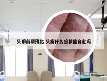 头癣前期预兆 头癣什么症状能自愈吗