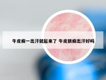 牛皮癣一出汗就起来了 牛皮肤癣出汗好吗