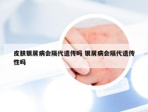 皮肤银屑病会隔代遗传吗 银屑病会隔代遗传性吗