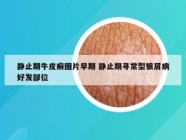 静止期牛皮癣图片早期 静止期寻常型银屑病好发部位