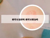 癣可以治好吗 癣可以根治吗